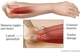 دکتر حسین ارجمند, ارنج تنیس بازان, بیماریهای عضلانی و اسکلتی, tennis elbow دکتر حسین ارجمند, ارنج تنیس بازان, بیماریهای عضلانی و اسکلتی, tennis elbow